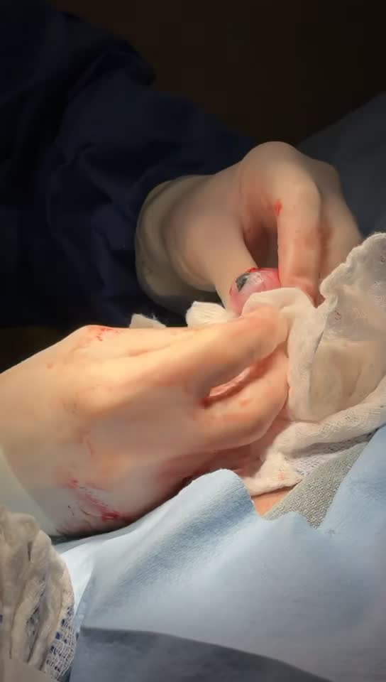 Gloved hands holding an AA battery during surgical removal, with blood and exposed tissue visible